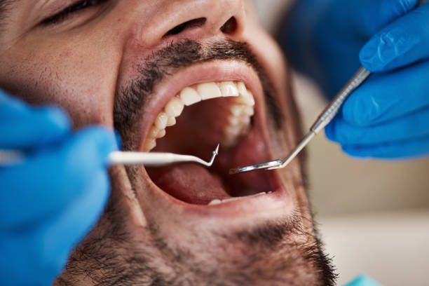 Best Emergency Wisdom Teeth Removal in North Falmouth, MA